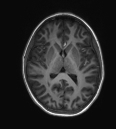 Structural MRI