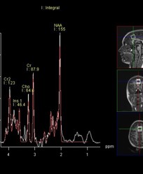 Spectroscopy MRI